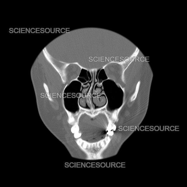 Septum Material Science Breakthrough Improves Debris Reduction Strategies